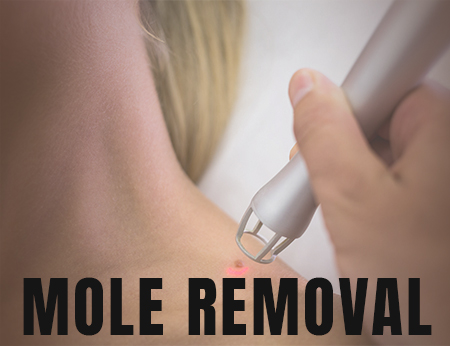 Mole Removal